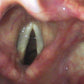 Picture of airway anatomy through a glidescope showcasing the epiglottis, glottis, vocal chords, cuneiform cartilage, vestibules, aryepiglottic fold, and corniculate cartilage 