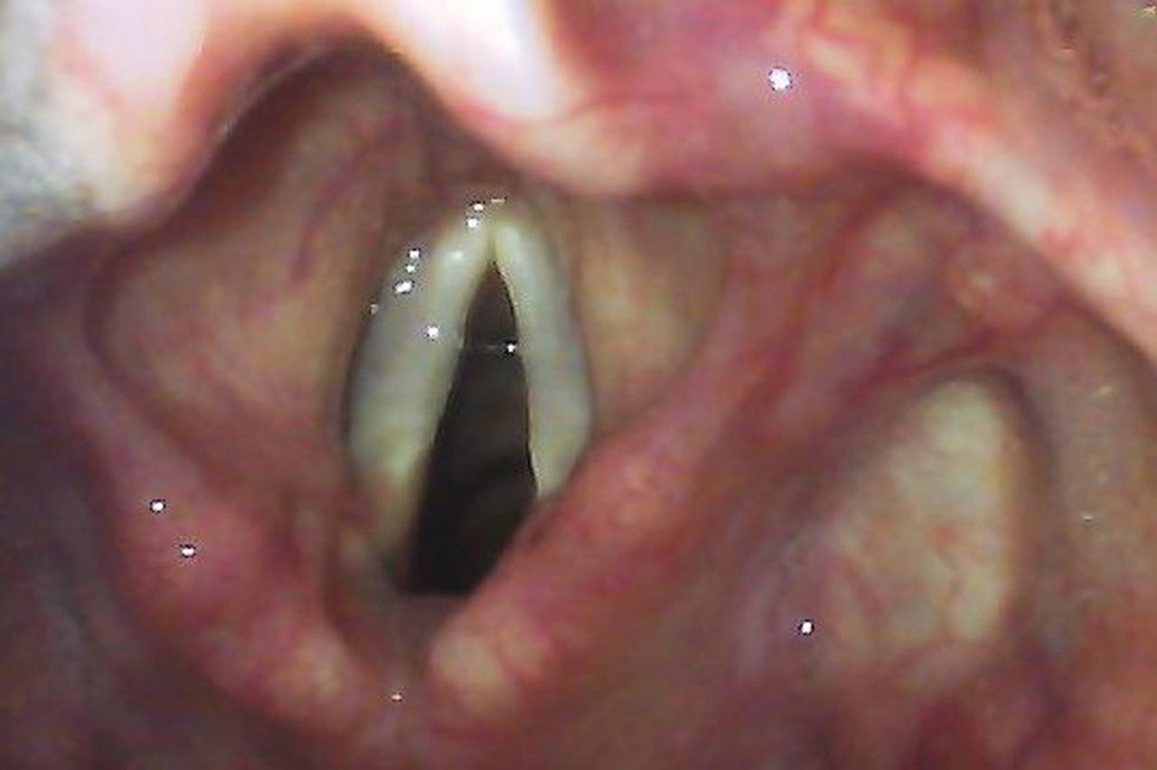 Picture of airway anatomy through a glidescope showcasing the epiglottis, glottis, vocal chords, cuneiform cartilage, vestibules, aryepiglottic fold, and corniculate cartilage 